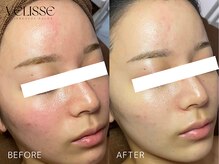 Velisse 表参道店【ヴェリス】《毛穴/肌質改善/ハーブピーリング/ニキビケア》/