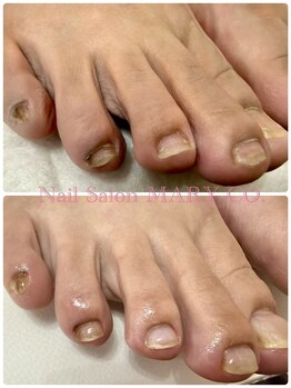 マリーシーオー(MARY-CO.)/フット深爪矯正