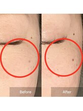 アイ(I)/目の下のシワたるみ改善