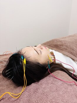 おはな整骨院 帯山院/美容鍼