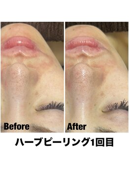 Sスタイルスタジオ 福岡天神/ハーブピーリング1回目のお客様