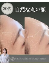 シェリー(Cherie)/30代額の窪みを丸く