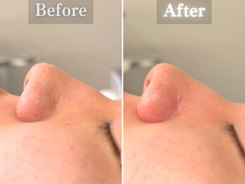 ボーンオム(Born Homme)/毛穴洗浄＋美容液導入：20代男性