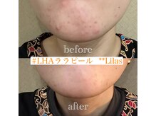 リラ(Lilas)/ニキビ肌から水光肌へ