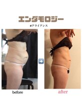 アイリス(AIRIS)/痩身/リンパケア/マッサージ