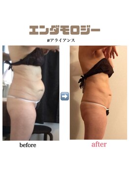 アイリス(AIRIS)/痩身/リンパケア/マッサージ