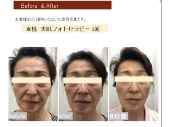 アンフィー 川西能勢口店(Une f`ee)/フォト美顔のビフォーアフター