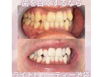 ライトビューティー 池袋店(LightBeauty)/症例写真