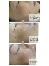 メリナ(Melina)/HITOYURAIエクソソーム導入