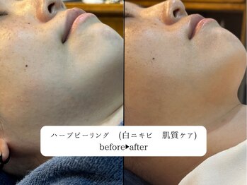 レオロ(leolo)/ニキビにハーブピーリング!