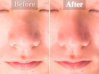 ボーンオム(Born Homme)/毛穴洗浄＋美容液導入：20代女性