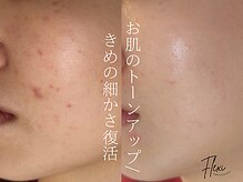 フレキシ 表参道(Flexi)の雰囲気(肌荒れ、毛穴トラブルはピーリング+肌細胞の強化で解決◎)