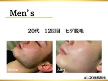 アルゴ 堺東駅前店(ALGO)/20代/ヒゲ脱毛/12回目