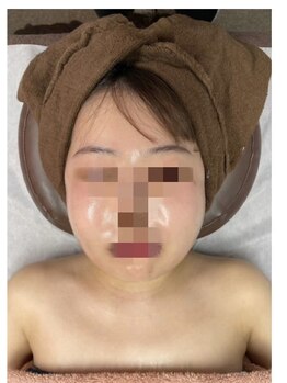 インディバケアプラチナム 恵比寿店/両顎手/術のアフターケア☆after