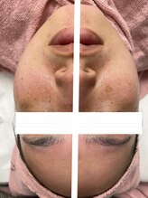 ランプシー(Lampsi)/臍帯血エステ