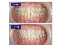 最近人気のセルフホワイトニング！県内最安値の衝撃価格！★