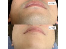 サロンドブランシール(salon de blanchir)/男性ひげ脱毛