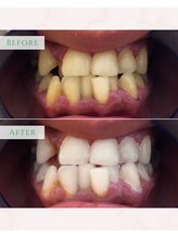 シカホワイトニングトウキョウ 笹塚店(CICA Whitening Tokyo)/ビフォーアフター(30代女性）