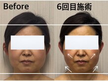 ベール(BEHL)/コルギのBefore After