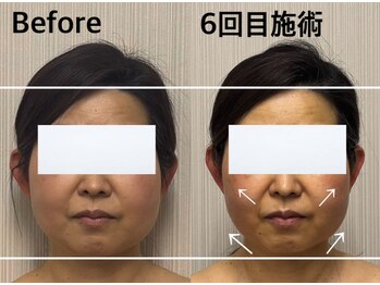 ベール(BEHL)/コルギのBefore After