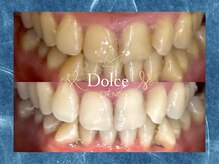 ドルチェ(Dolce)/ビフォーアフター