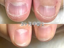 グラシナ なんば店/深爪/自爪育成/フィルイン