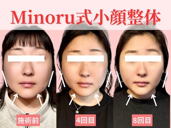 フレキシボディ(FlexiBody)/小顔施術ビフォーアフター #18