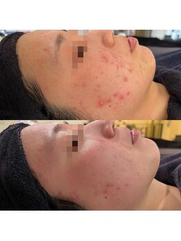 ビーエスアクアビューティー/リベルピーリング1回施術