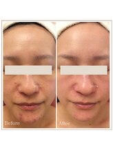 ベルタ(BELTA)/ケア前→6ヶ月後　ニキビ/肌荒れ