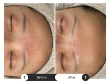 リジュ(Reje)/赤み&ニキビケア