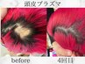 【育毛促進/つむじ】ダウンタイムなし!!プラズマサイエンス¥6600