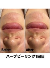 Sスタイルスタジオ 福岡天神/ハーブピーリング1回目のお客様