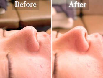 ボーンオム(Born Homme)/毛穴洗浄＋美容液導入：20代女性