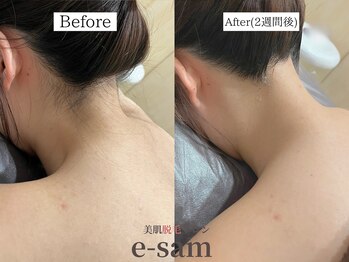 イーサム 高槻摂津富田店(e-sam)/丸ごと全身脱毛