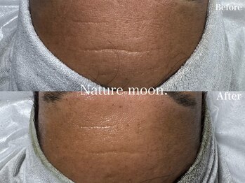 ナチュールムーン(Nature moon.)/ハーブピーリング