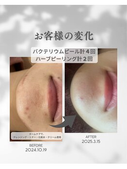プレジール(Plaisir)/お手入れ6回・ホームケア使用