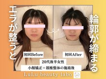 ルルラボ(LuLu beauty labo)/エラ改善で締まる輪郭