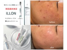 マイルーチェ 可児川合店(MyLuce)の雰囲気（韓国最新美容でニキビケア♪）
