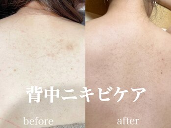 ネオリー(neorii)/背中ニキビケア