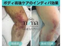 ナナ 銀座(Nana)/術後ケアしたいお客様必見！
