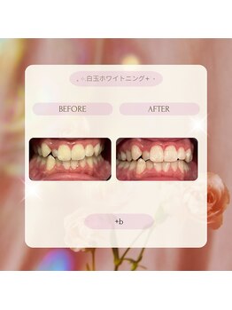 プラスビーセルフ(+b self)/ホワイトニングビフォーアフター