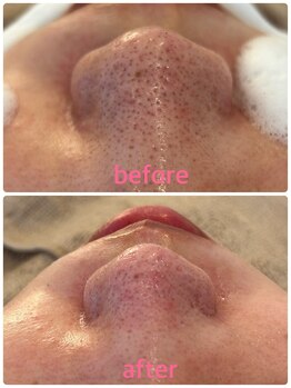 マナ(mana)/大阪 梅田 毛穴洗浄フェイシャル