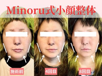 フレキシボディ(FlexiBody)/小顔施術ビフォーアフター #19