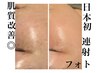 口コミ最強【シミ改善/小顔/毛穴】徳島唯一シミ改善特化連射式光フェイシャル