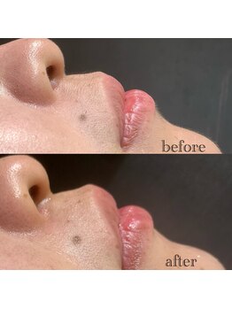 エヌドット バーバーギンザ(N.BARBER GINZA)/顔剃りでトーンup☆