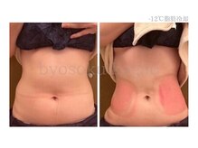 メディカルエステ 新宿店/＊日本初-12℃脂肪冷却症例＊