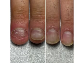 トレフル(Trefle)の写真/【歴20年超/深爪矯正のスペシャリスト】丸爪/貝爪/形の悪い爪等を再発させたくないあなたに！角質ケアも◎