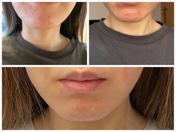 ケンビラク(Kenbiraku 健美楽)/お得意様 ニキビケア小顔整体2回