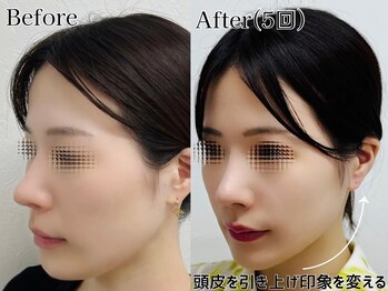 プルチャームエテルナ 代官山店(Pulchram eterna)/たるみの新常識!頭皮リフト