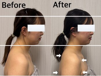 ベール(BEHL)/コルギのBefore After